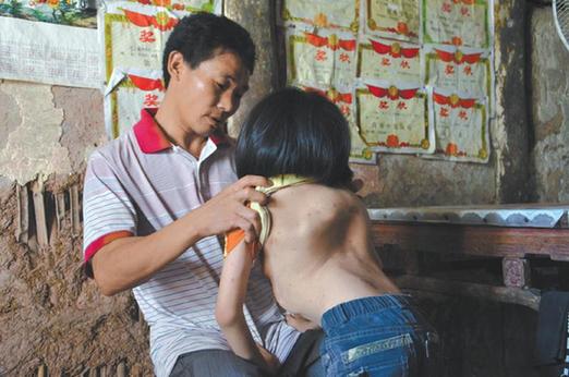 有嚴(yán)重脊椎畸形及胸腔隆突病的李文霞。