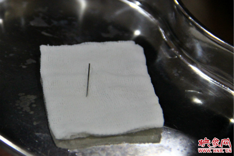 上午11點(diǎn)30分許，小龍腦中鋼針已經(jīng)成功取出。