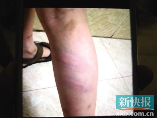 小宇腿部有明顯瘀痕。 翻拍自家屬手機(jī)