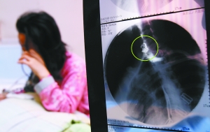 假牙上的鋼絲刺破食管，而薄薄的食道壁緊貼主動脈血管，極易造成血管破裂