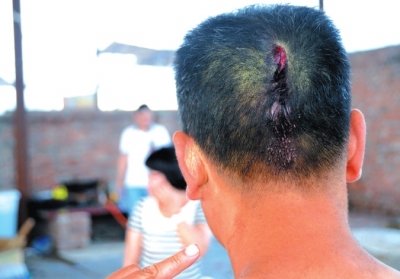 崔先生頭部受傷。京華時報記者趙思衡攝/視頻