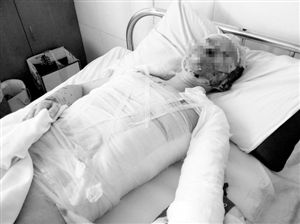 周小姐的頭、頸、軀干、四肢均被燒傷，其中面部燒傷最為嚴(yán)重。