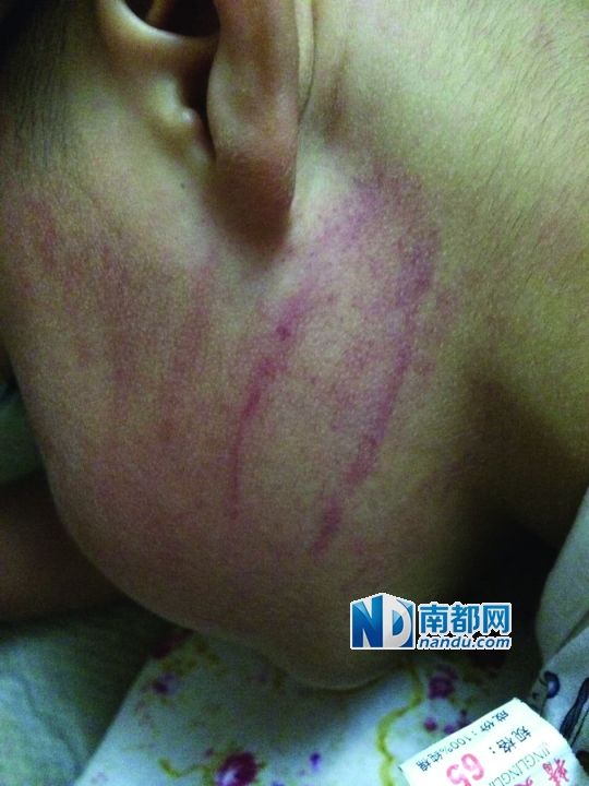 小逸臉上淤痕清晰可見。