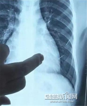 17歲少年體內(nèi)扎進(jìn)4根鋼針 1根已插入心臟4厘米