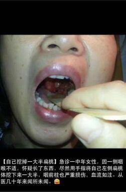 圖片來自市三醫(yī)院耳鼻喉科醫(yī)生朋友圈