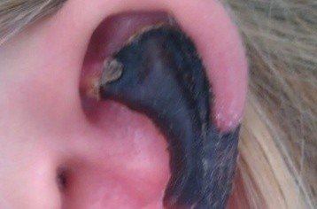 荷蘭女子旅游途中被蜘蛛咬，耳軟骨溶解變黑。