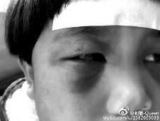 6月2日，網(wǎng)曝渭南市臨渭區(qū)一不滿(mǎn)5歲的女童遭奶奶毆打，眼圈青腫，引起網(wǎng)友關(guān)注，但孩子父母和爺爺均稱(chēng)是摔倒導(dǎo)致。相關(guān)部門(mén)介入調(diào)查發(fā)現(xiàn)確為奶奶毆打所致，鑒于其身體原因已進(jìn)行批評(píng)教育。