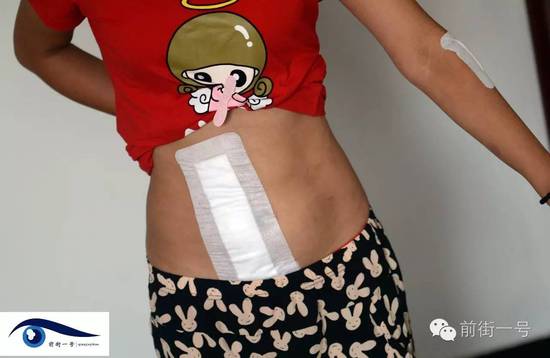 小金腹部的傷口。