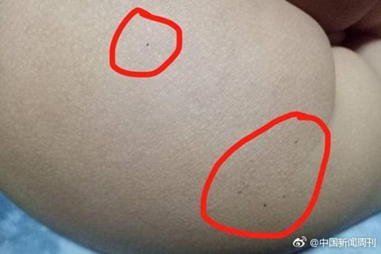據(jù)多名紅黃藍(lán)(新天地分園)家長(zhǎng)反映，孩子腿部、屁股、腋下出現(xiàn)針眼。