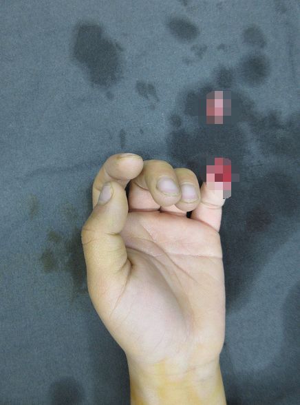 嚇哭！6歲男孩被夾斷手指 罪魁禍?zhǔn)拙故切７? oldsrc=