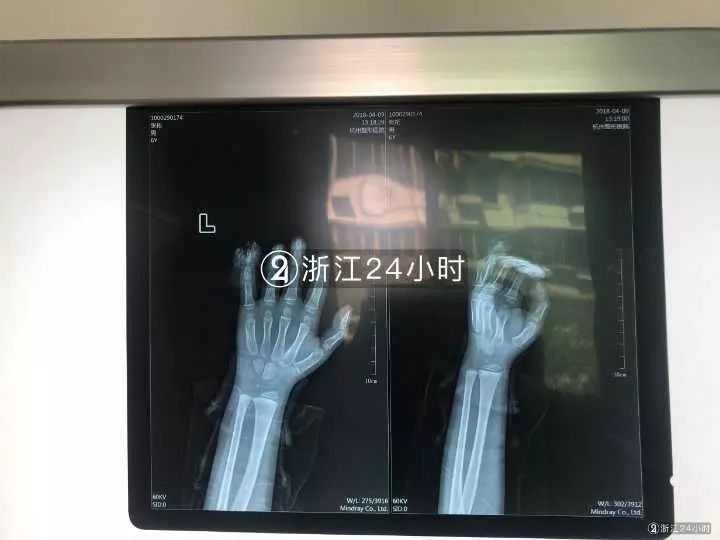 嚇哭！6歲男孩被夾斷手指 罪魁禍?zhǔn)拙故切７? oldsrc=