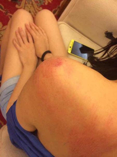 “跑男”真的很拼！baby朋友圈曬后背紅腫照