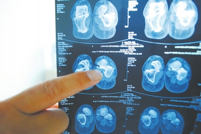 X光片顯示,確實有一根殘留的螺絲釘。