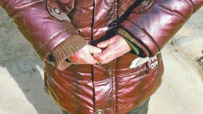 長(zhǎng)期受損的手指，已經(jīng)長(zhǎng)在了一起。