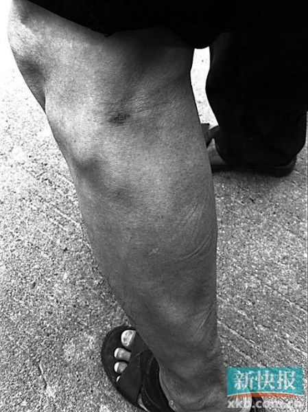 傷者身上遺留的彈痕。