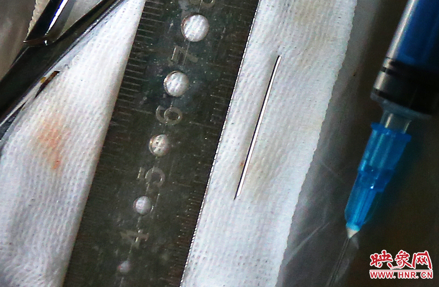 上午11點42分，大龍顱內(nèi)的鋼針被取出