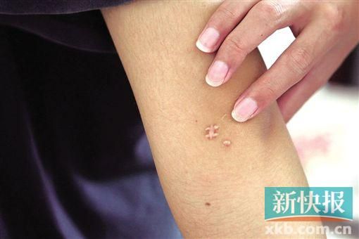 取出針后李星兒手臂留下了傷口。新快報記者 張國鋒/攝