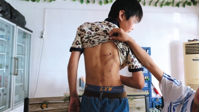 　昨日，奶西村，被打的小剛后背上條條瘀痕依然明顯。