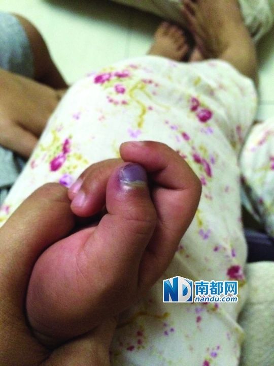 小逸手指被夾傷。