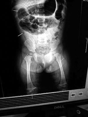 目前體內(nèi)的12根鋼針多分布在孩子的臀部，一根在腹部，其余3根在胸腔附近，其中一根很接近心臟