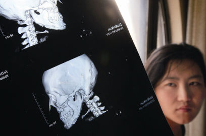 國內(nèi)醫(yī)院CT顯示，如今靳魏坤的鼻子假體是歪的，連下巴也是歪的