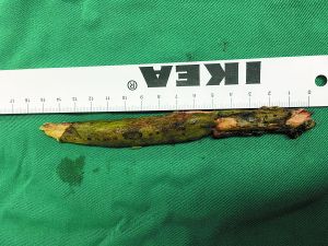 插入男子腦內(nèi)的樹枝。