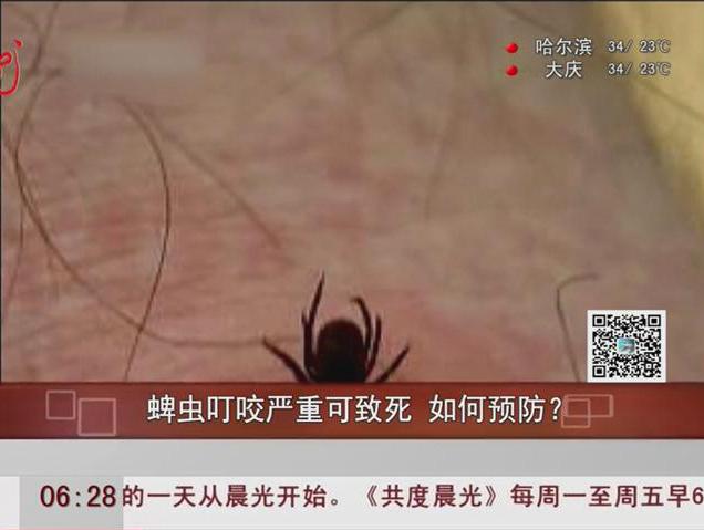 蜱蟲叮咬嚴(yán)重可致死如何預(yù)防？